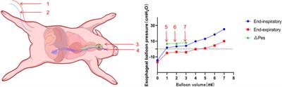 Esophageal pressure monitoring and its clinical significance in severe blast lung injury